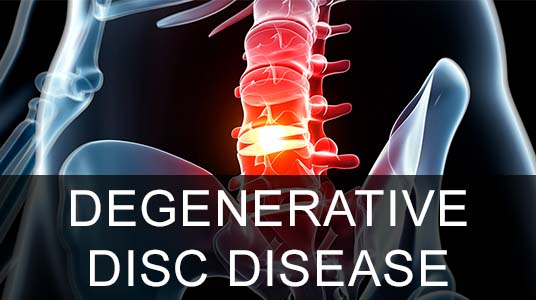 Spinal Decompression | Fort Myers | Neck Pain, Back Pain, Sciatica